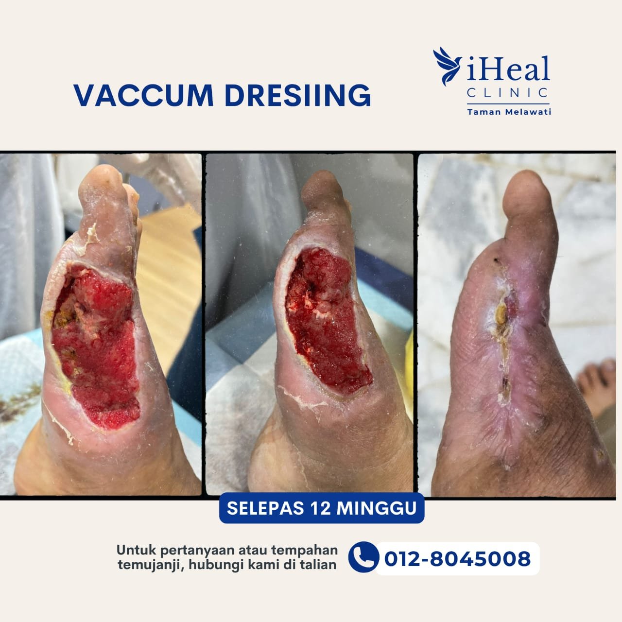 cuci-luka-diabetik-vacuum-dreesing