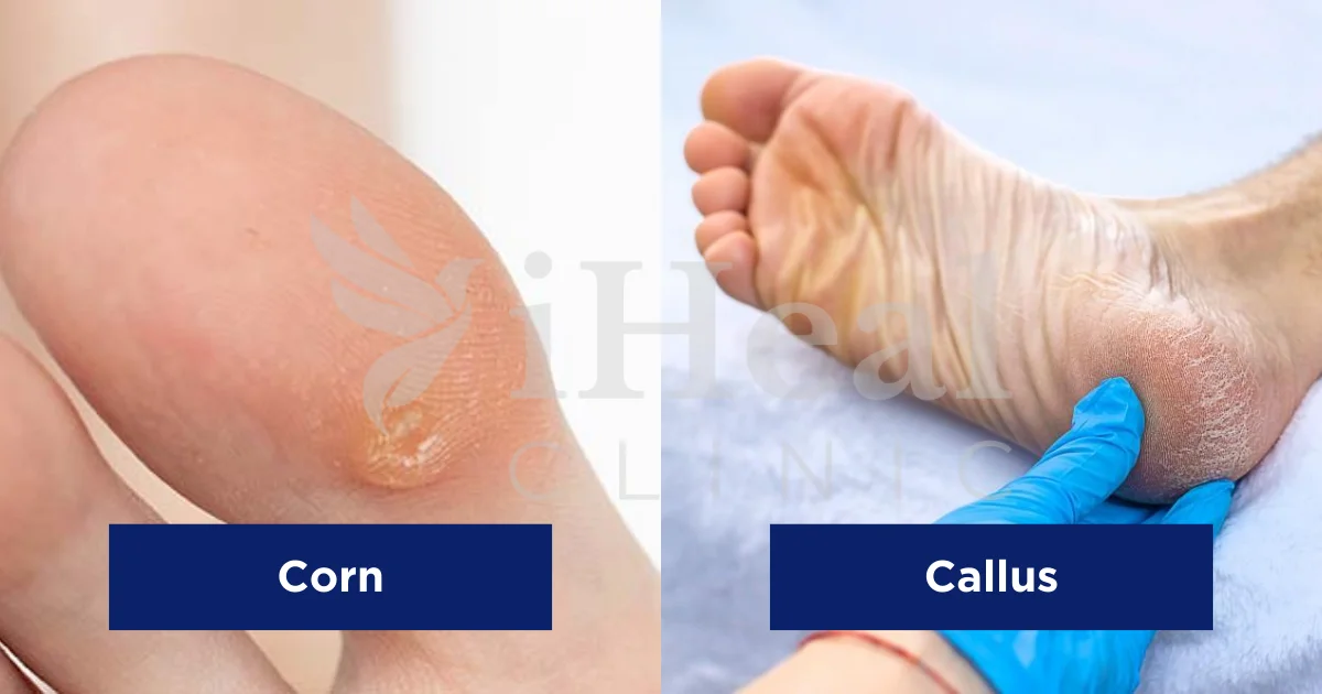 kematu-luka-kencing-manis