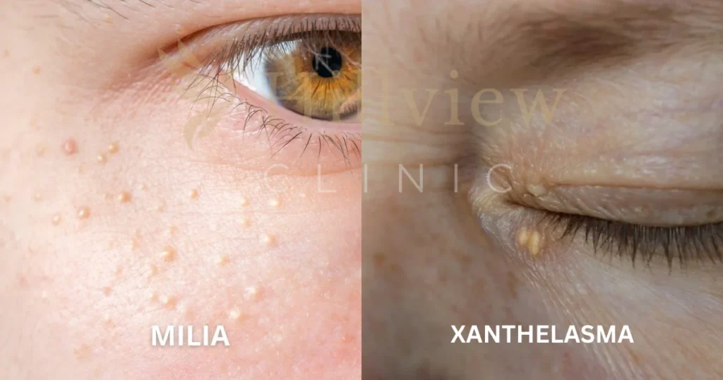 biji-kolesterol-di-mata