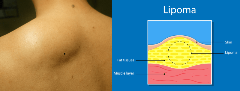ketulan-di-leher-lipoma