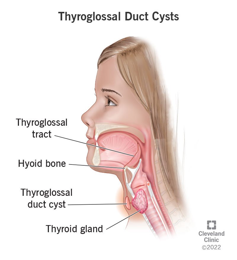 ketulan-di-leher-thyroglossal-duct-cyst