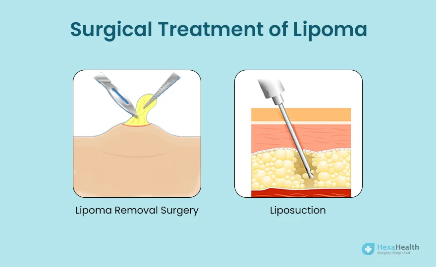minor-surgeri-lipoma-removal