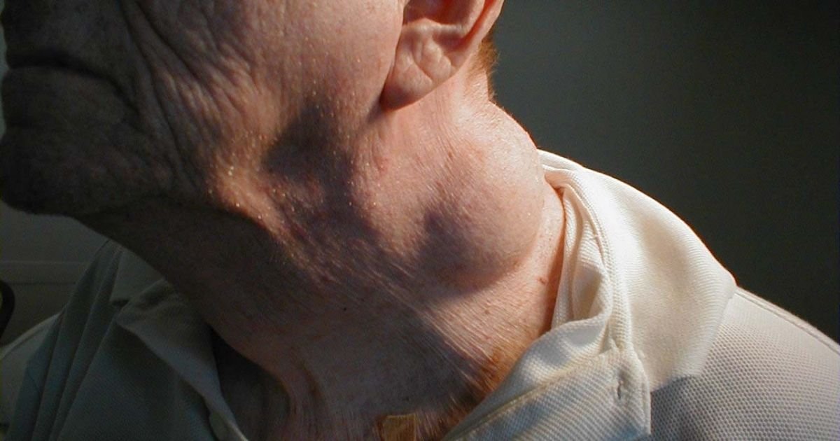 punca-ketulan-di-leher